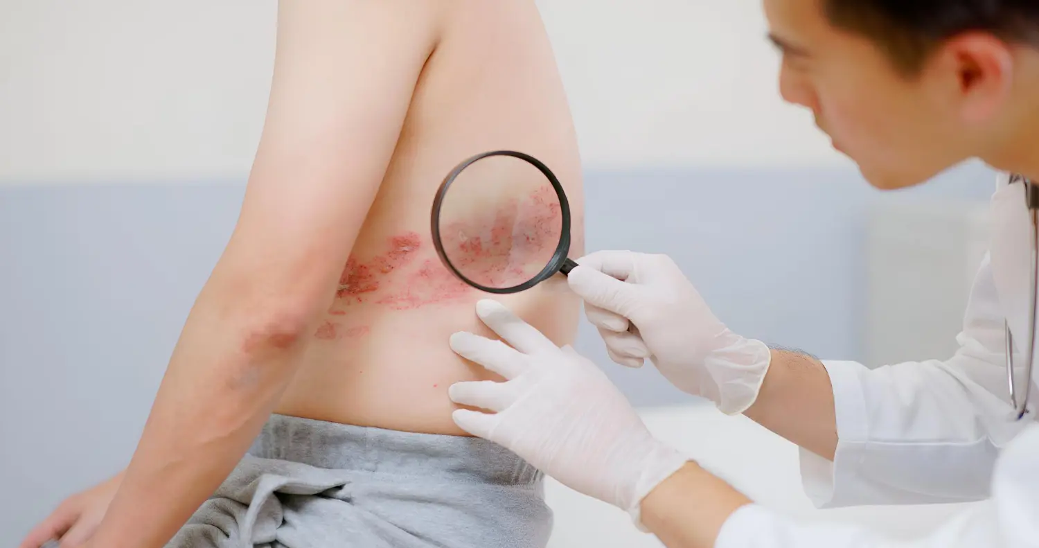 Shingles Explained: Symptoms, Causes, and How to Reduce Your Risk
