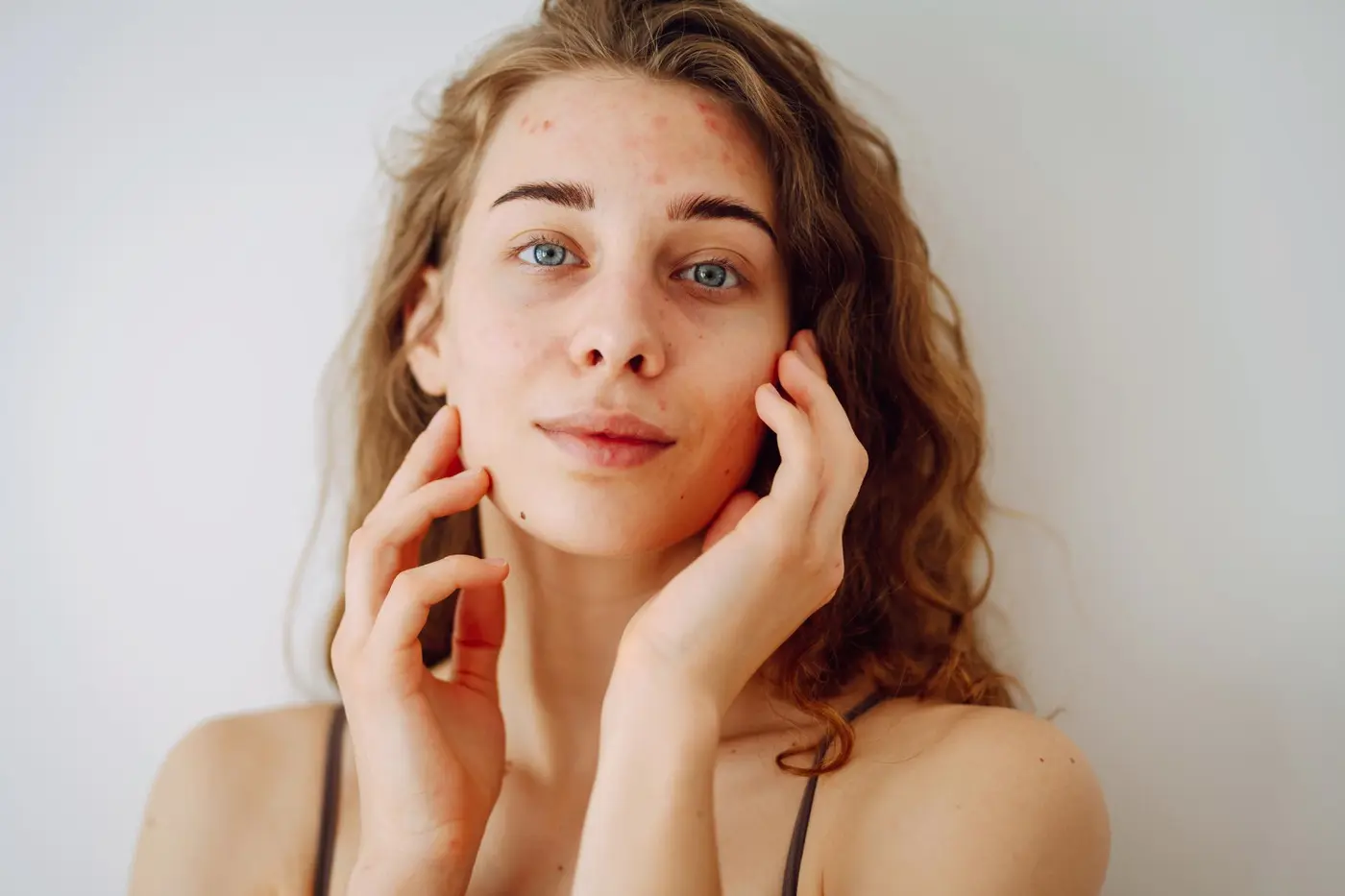 What Causes Adult Acne? Symptoms, Tr... post image