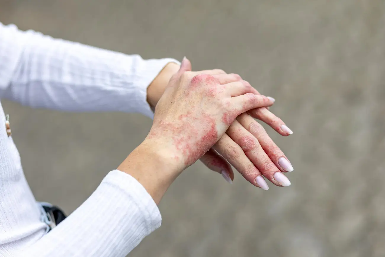 Adult Eczema: Why It Happens and How It Can Be Managed