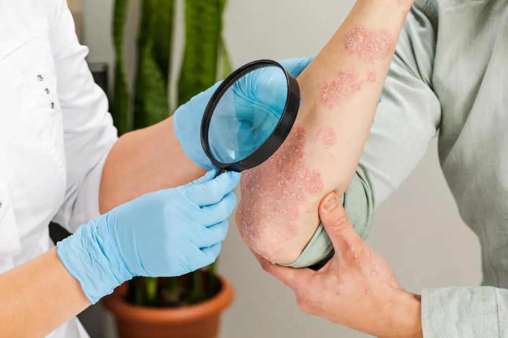 How Adult Eczema is Diagnosed