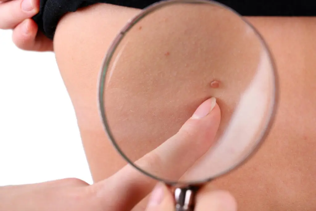 The ABCDE Rule for Checking Moles