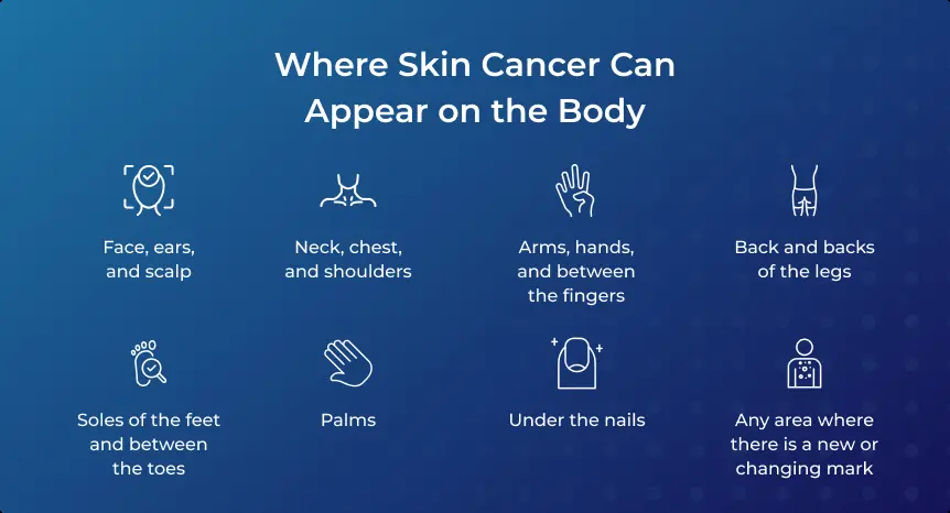 Where Skin Cancer Can Appear on the Body